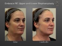 EmbraceRF before and after