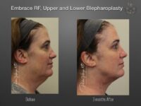 EmbraceRF before and after