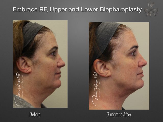 EmbraceRF before and after