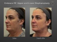 EmbraceRF before and after