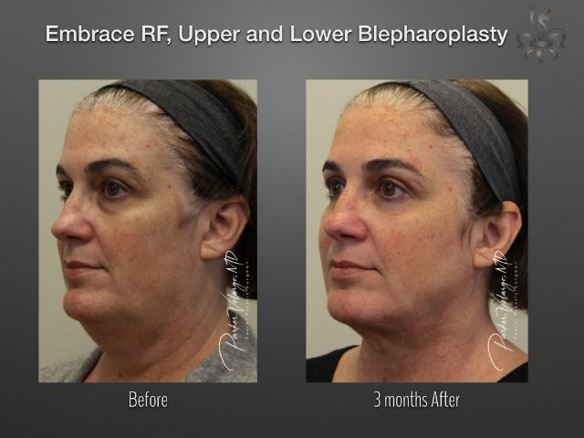 EmbraceRF before and after