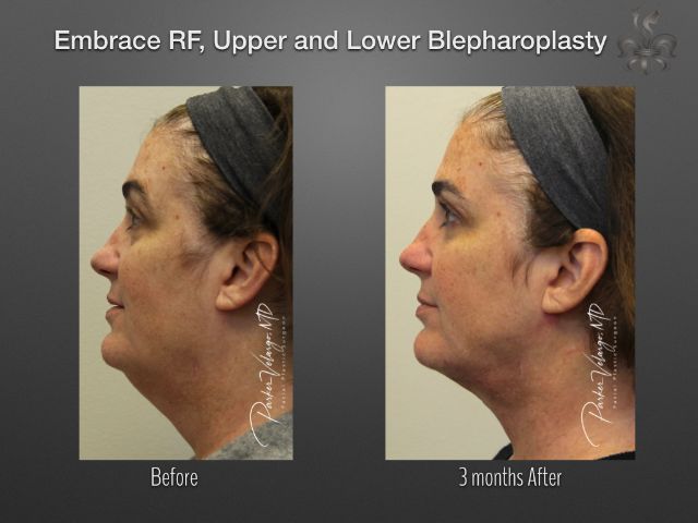 EmbraceRF before and after