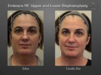 EmbraceRF before and after