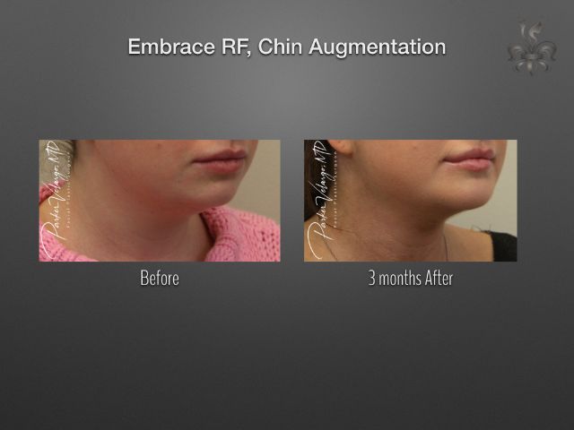 EmbraceRF before and after