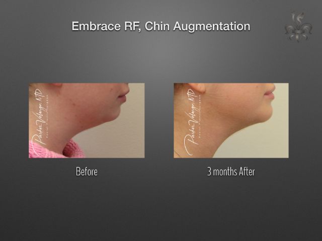 EmbraceRF before and after