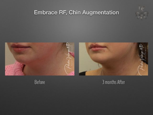 EmbraceRF before and after