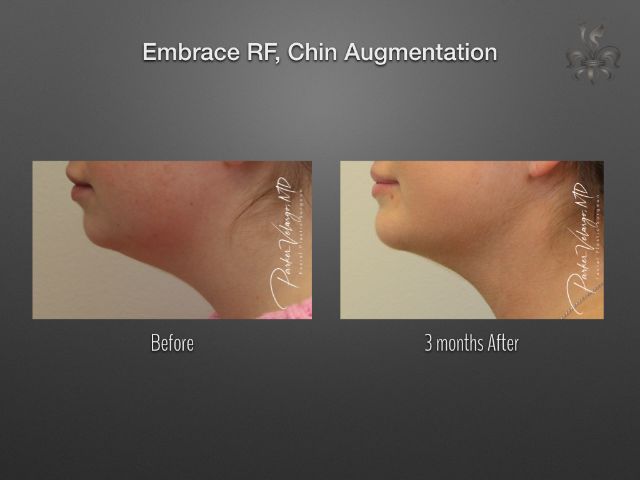 EmbraceRF before and after