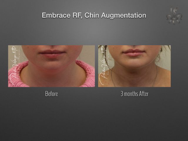 EmbraceRF before and after