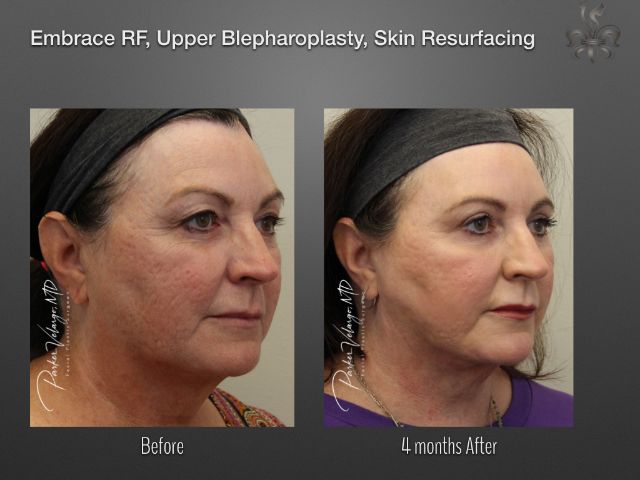 EmbraceRF before and after