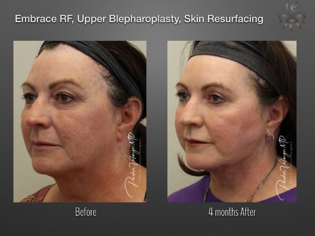 EmbraceRF before and after