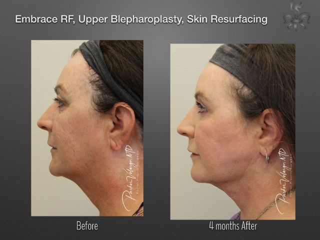 EmbraceRF before and after