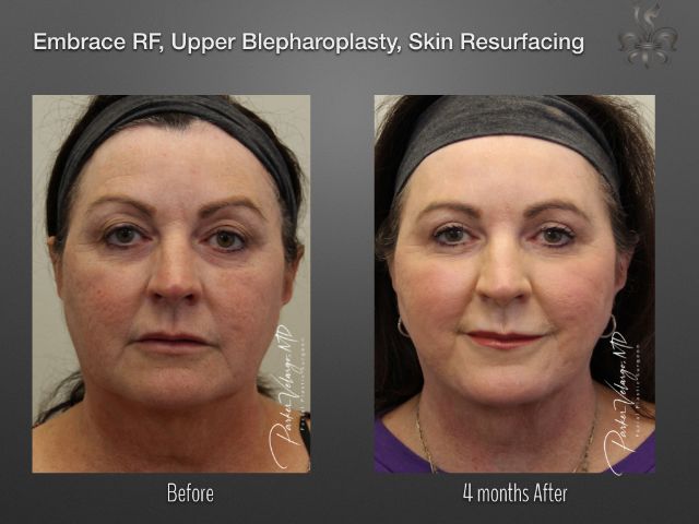 EmbraceRF before and after