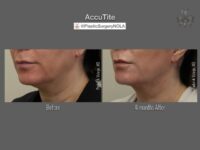 EmbraceRF before and after