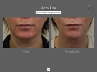 EmbraceRF before and after