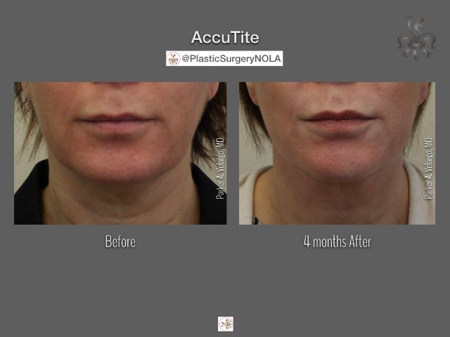 EmbraceRF before and after