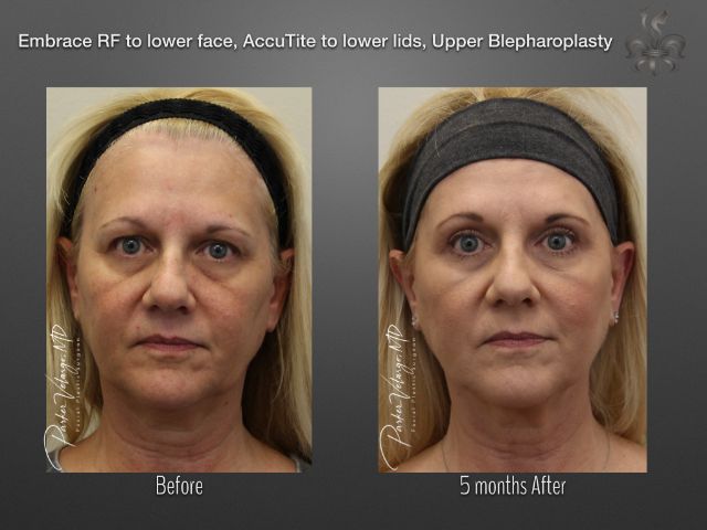 EmbraceRF before and after