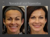 facelift before and after