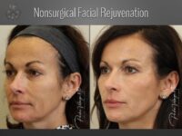 facelift before and after