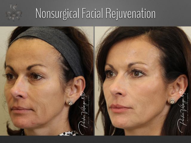 facelift before and after