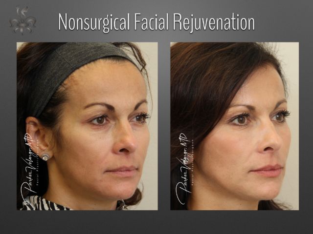 facelift before and after