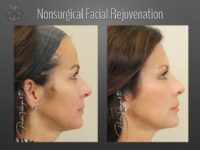 facelift before and after
