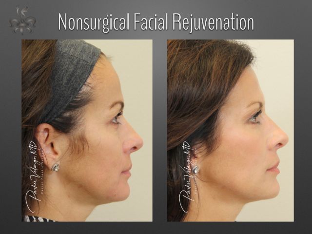facelift before and after