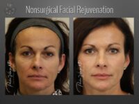 facelift before and after