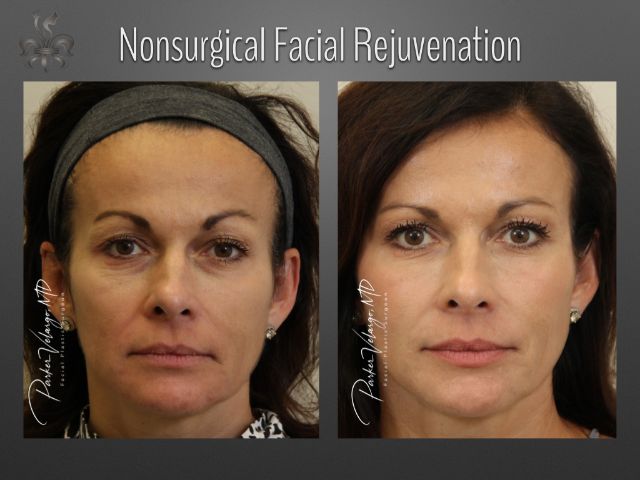 facelift before and after