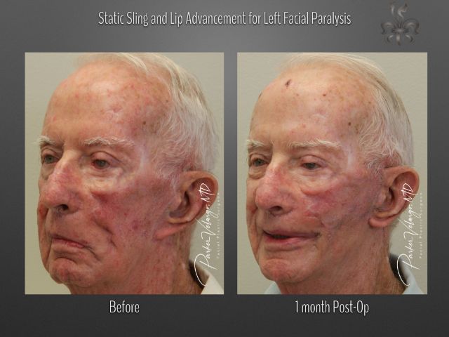 facial paralysis surgery before and after