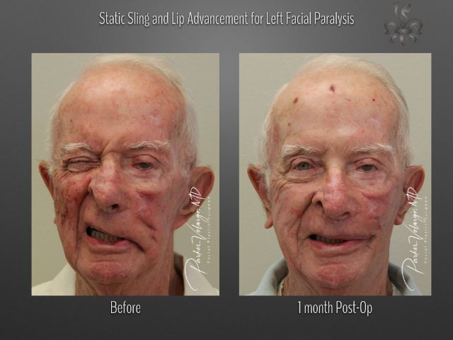 facial paralysis surgery before and after