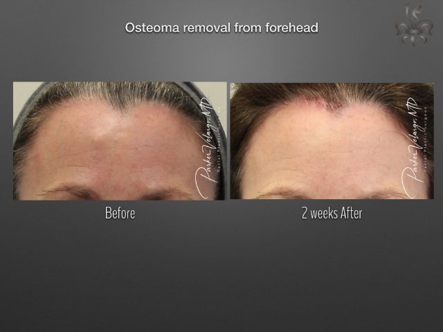 osteoma removal before and after