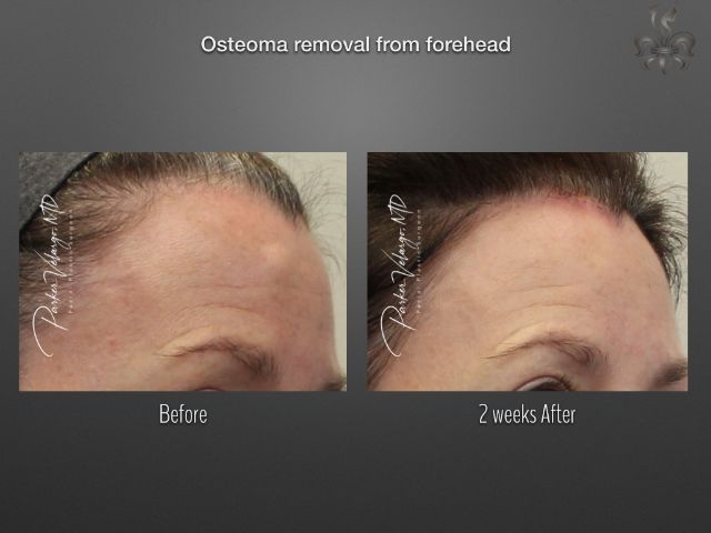 osteoma removal before and after