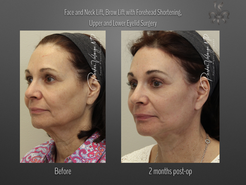 hairline restoration before and after