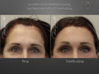 hairline restoration before and after