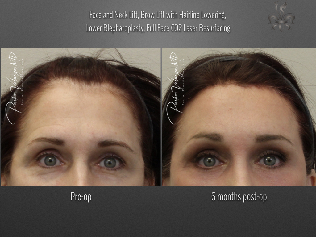 hairline restoration before and after