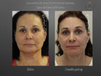 hairline restoration before and after