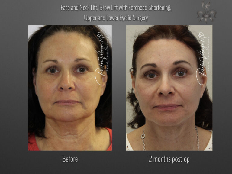 hairline restoration before and after