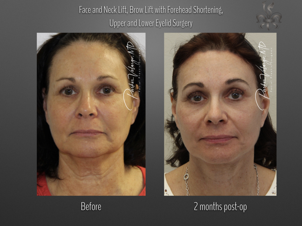 hairline restoration before and after