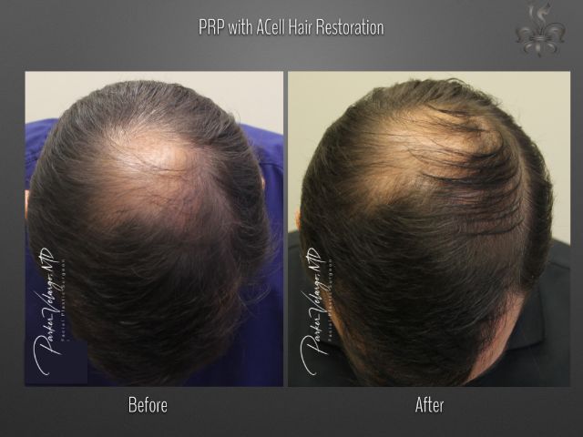 hairline restoration before and after