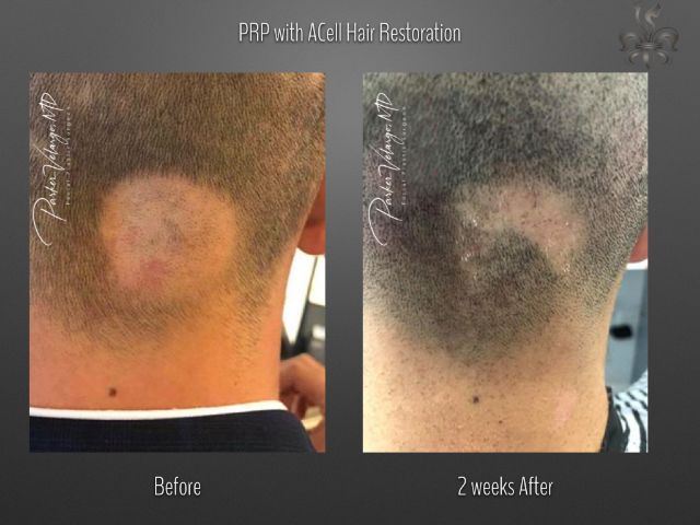 hairline restoration before and after