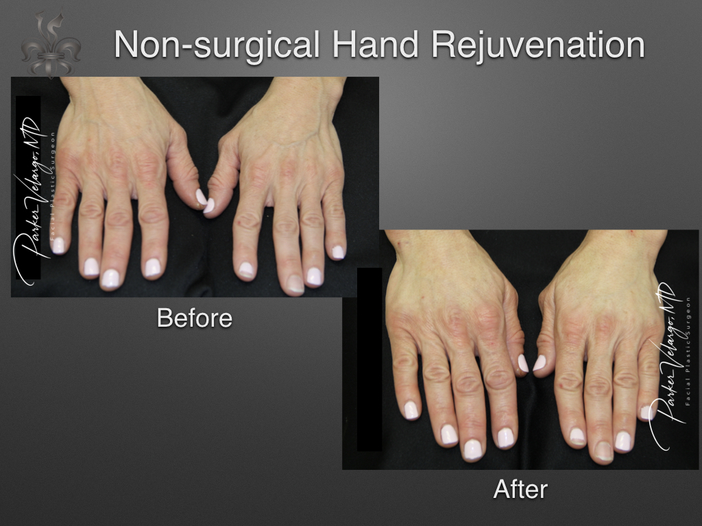 hand rejuvenation before and after