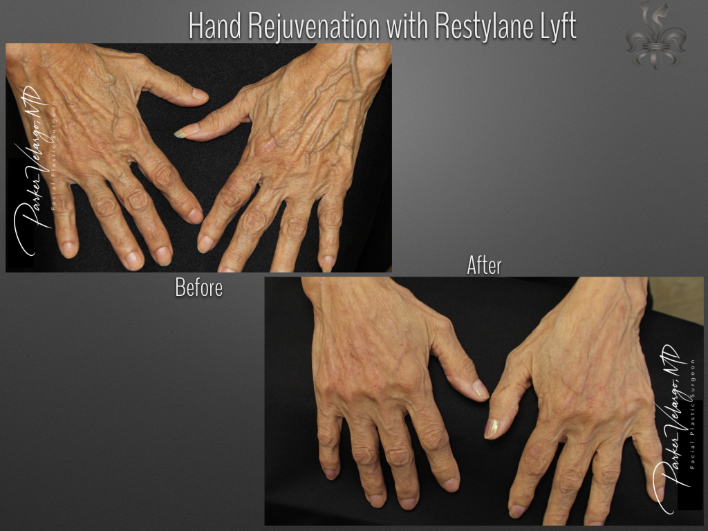 hand rejuvenation before and after