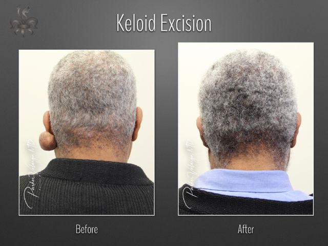 keloid excision before and after