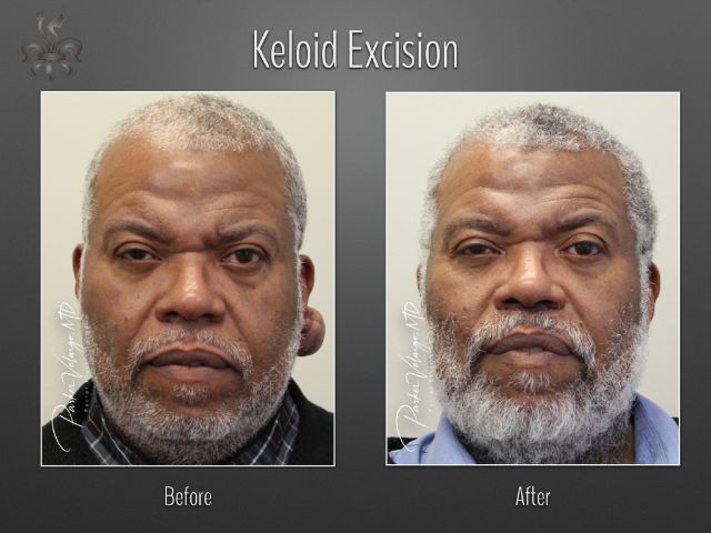 keloid excision before and after