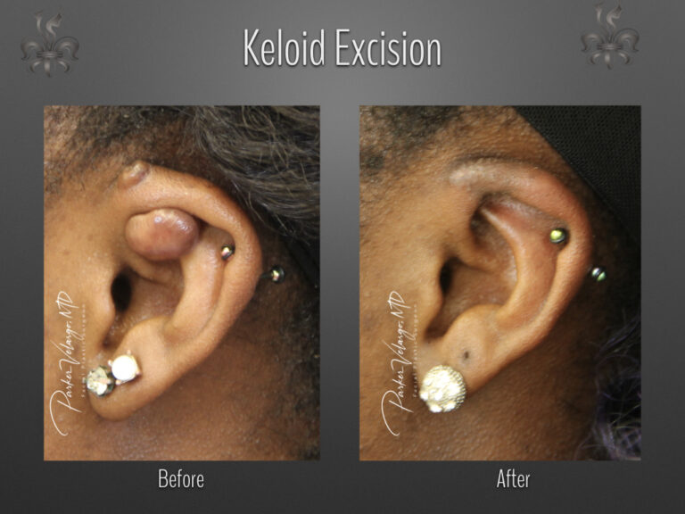 keloid excision before & after