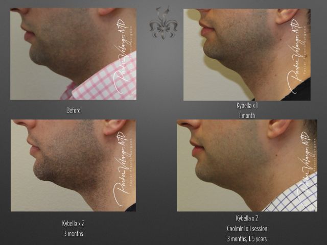 Kybella before and after