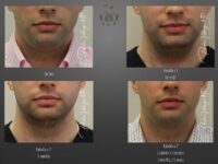 Kybella before and after