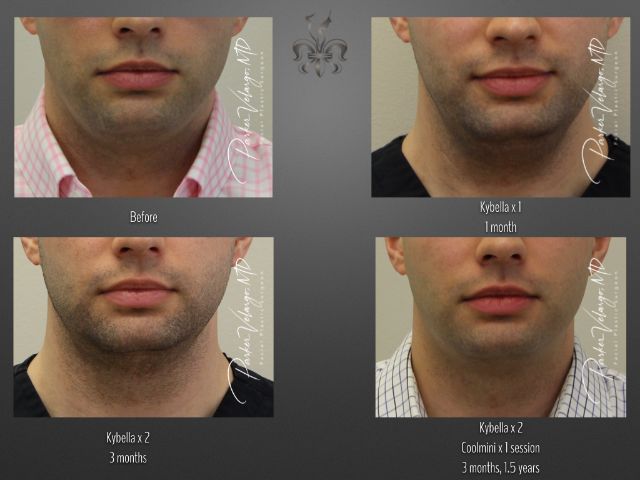 Kybella before and after