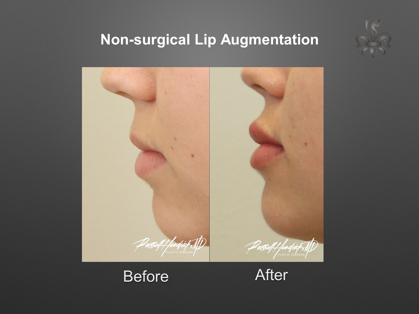 lip augmentation before and after
