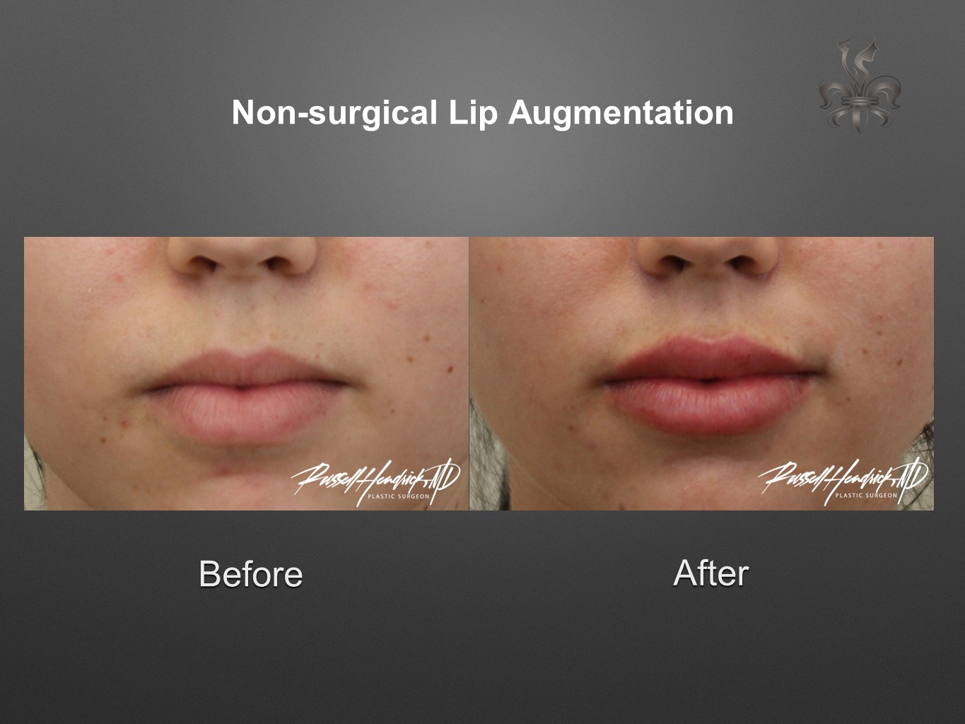 lip augmentation before and after